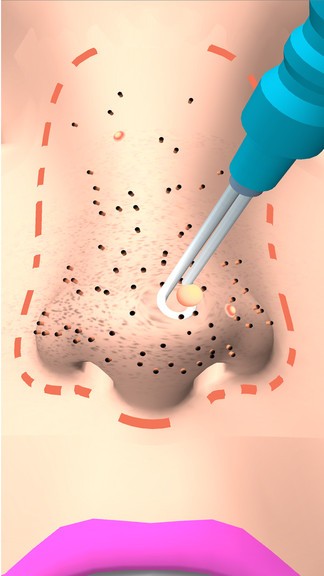 擠黑頭大師 v0.2 安卓版 0