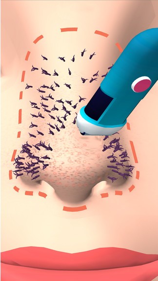 擠黑頭大師 v0.2 安卓版 2