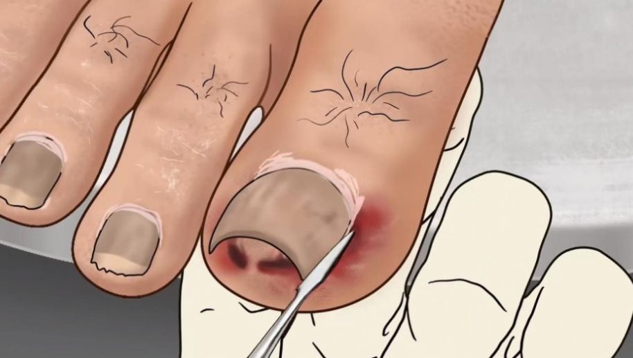 修腳足疔模擬器 v1.0 安卓版 2